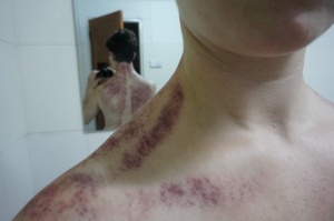 The unsightly results of "cupping", a Chinese medicine technique to reduce tension and draw out toxins from the body.